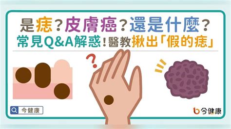 臉上為什麼會長痣|是痣？皮膚癌？還是什麼？常見Q&A解惑！醫教揪出「。